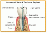 Implant dentar Alpha Bio 300 euro