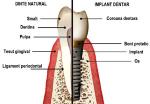 Implantologie, implant dentar ieftin